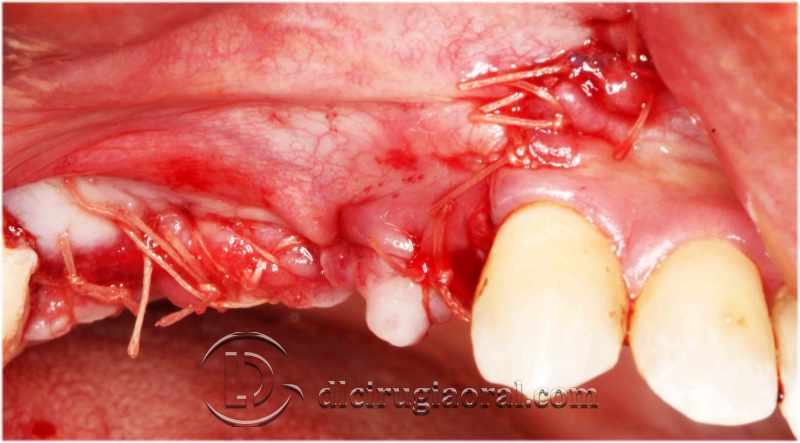 explantation and implantation with sinus lift
