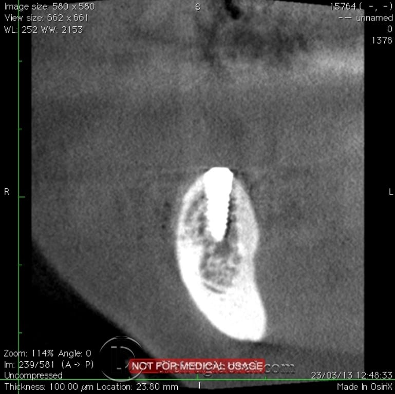 implant surgery in the mandible