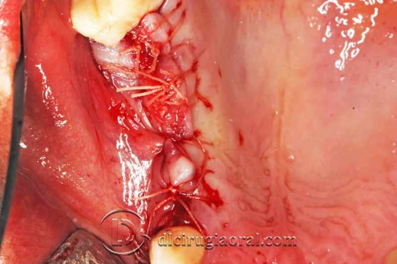 explantation and implantation with sinus lift