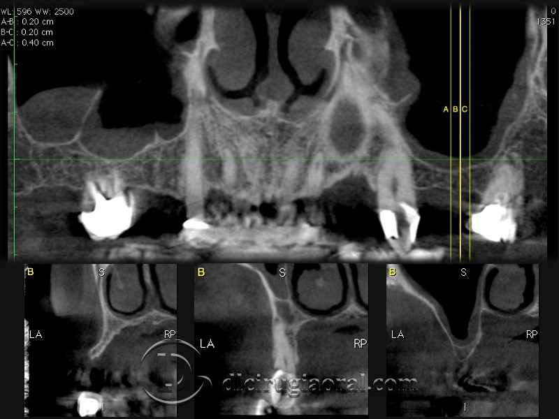 block regeneration and sinus lift