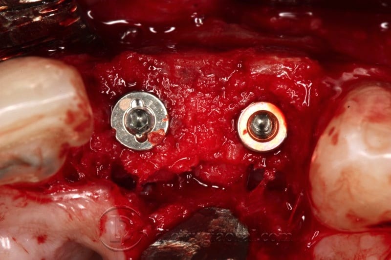 Implant Surgery After Reconstruction in the Anterior Maxilla