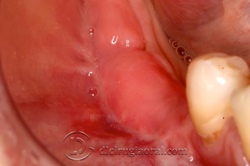 implant surgery in the mandible