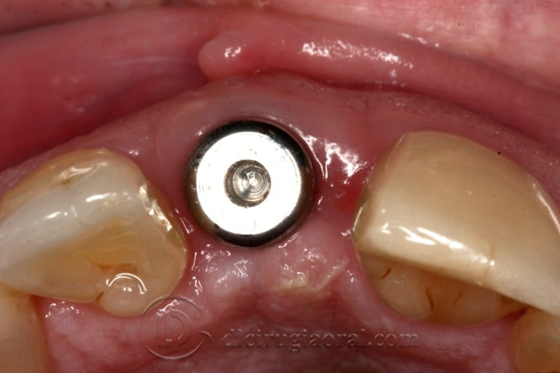 atrophy in central incisor