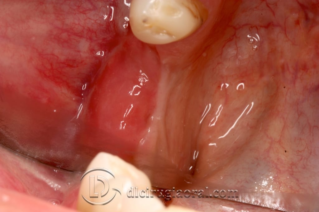 implant surgery in the mandible