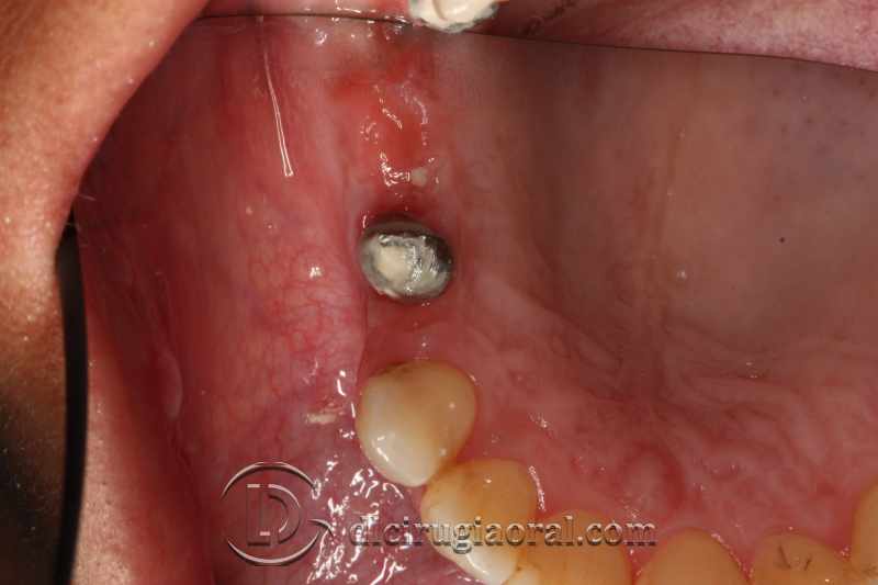 explantation and implantation with sinus lift