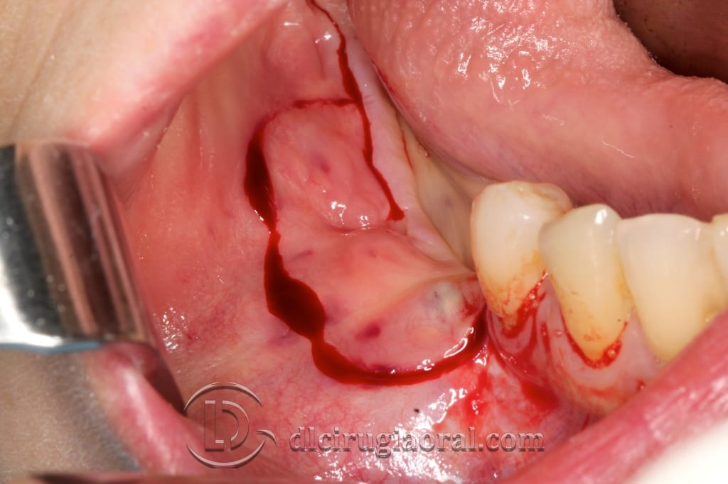 implant surgery in the mandible