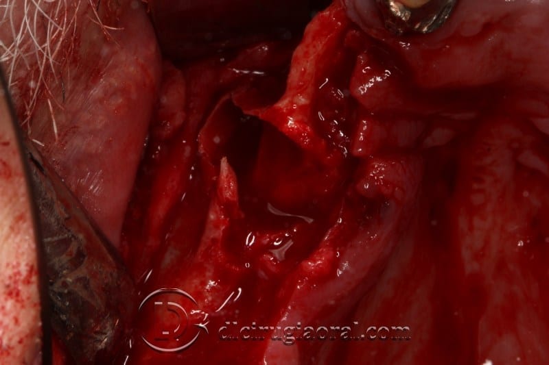 block regeneration and sinus lift