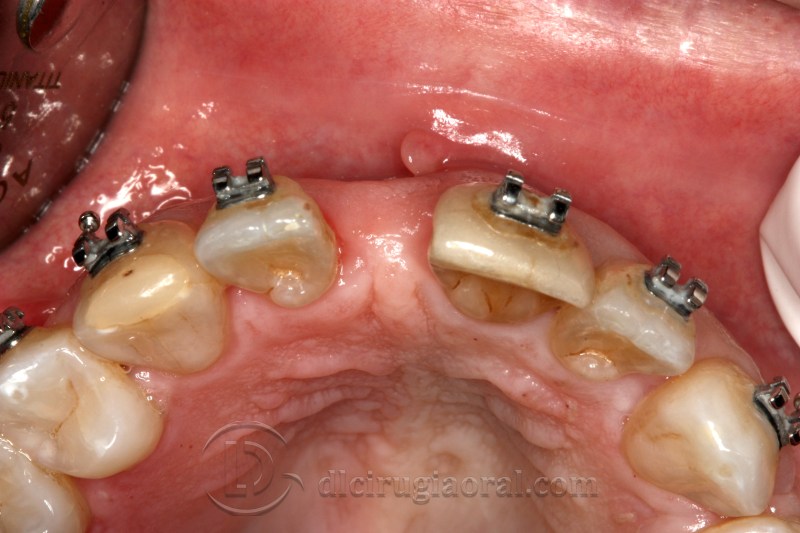 atrophy in central incisor