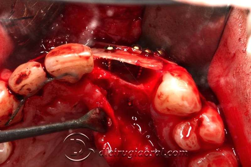 Reconstruction occlusal view