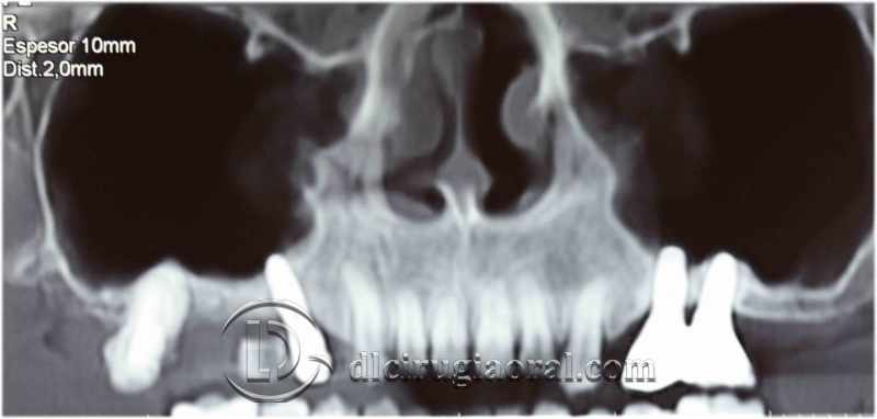 explantation and implantation with sinus lift