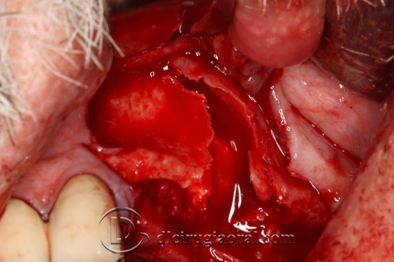 block regeneration and sinus lift