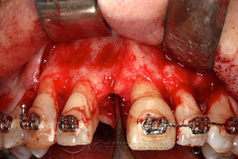 atrophy in central incisor