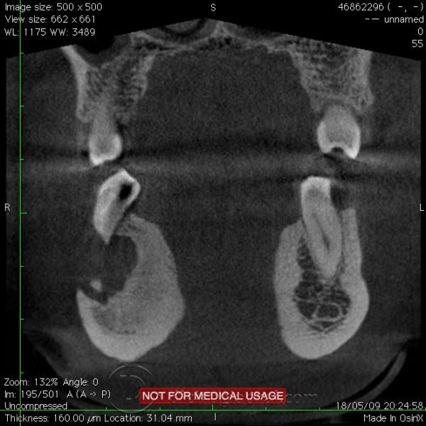 Mandibular Reconstruction Following Cyst Recurrence
