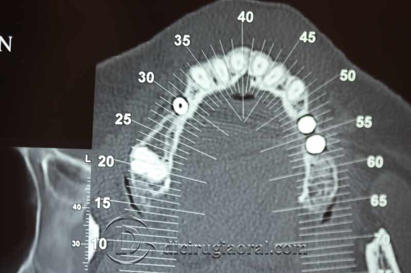 explantation and implantation with sinus lift