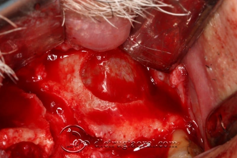 block regeneration and sinus lift