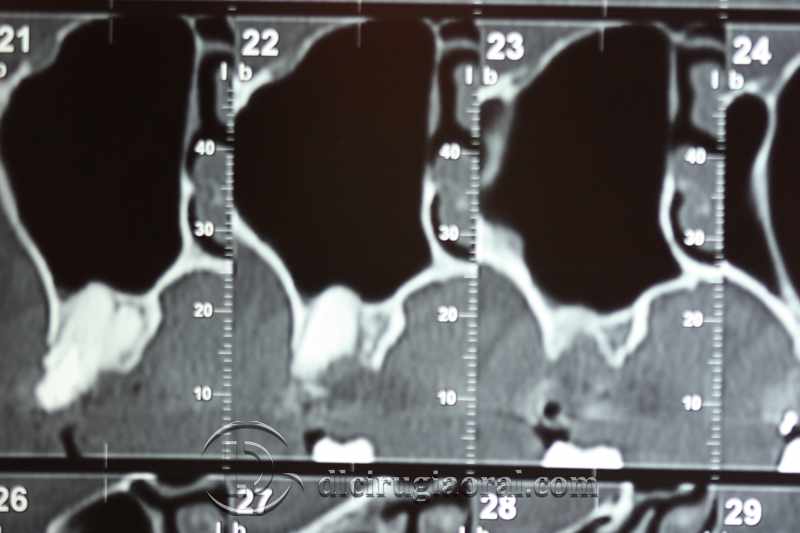 explantation and implantation with sinus lift