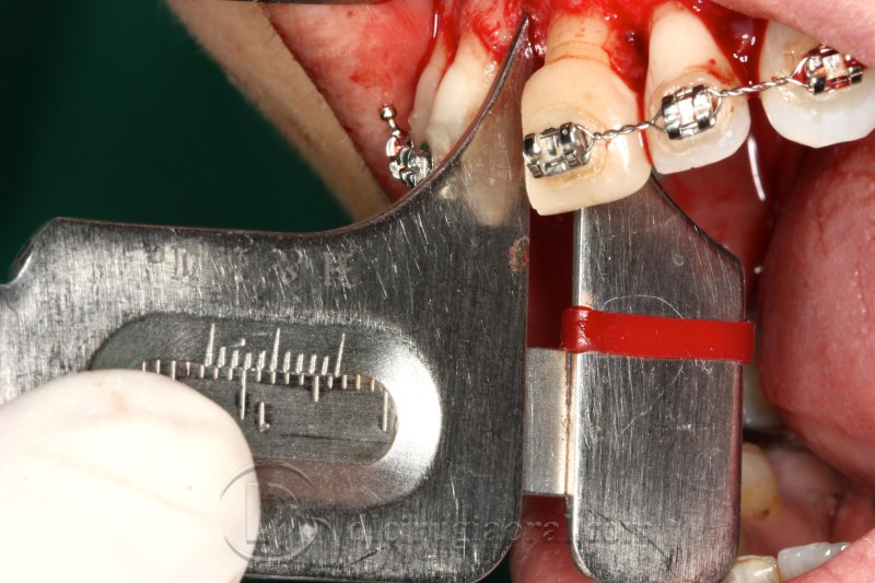 atrophy in central incisor