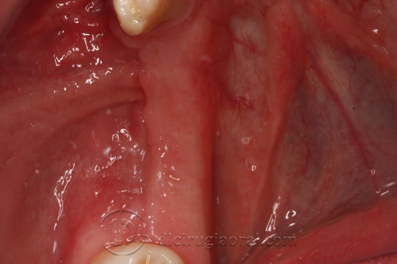 mandibular reconstruction
