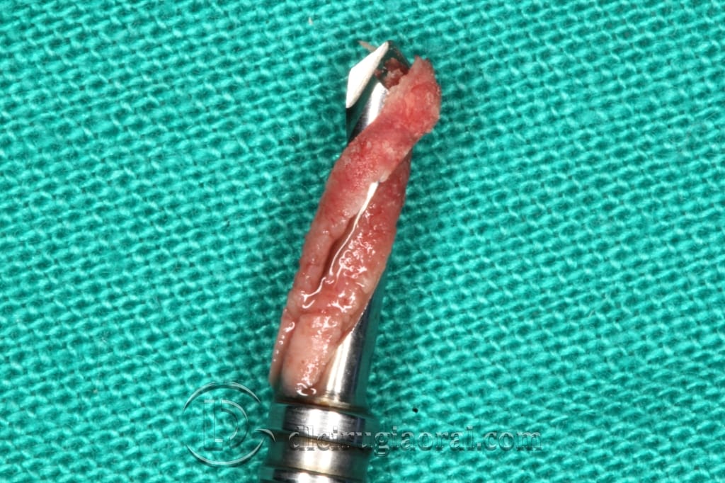 implant surgery in the mandible