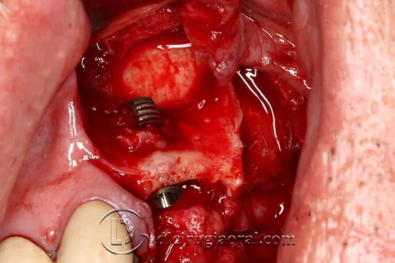 block regeneration and sinus lift
