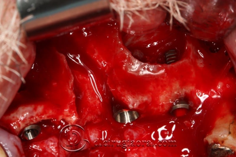 block regeneration and sinus lift