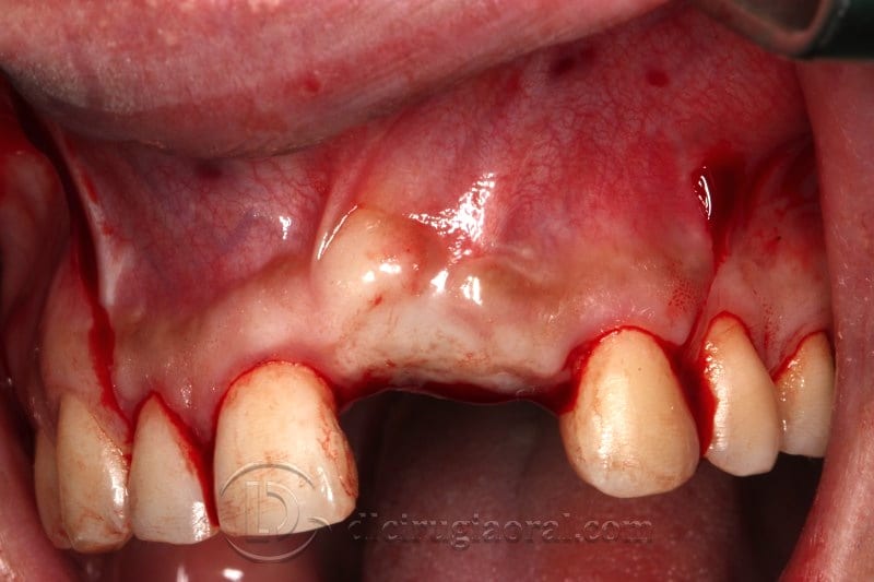 Incision