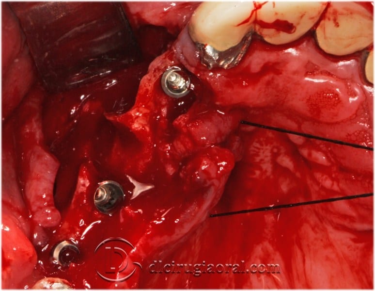 block regeneration and sinus lift