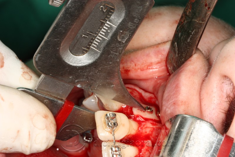 atrophy in central incisor