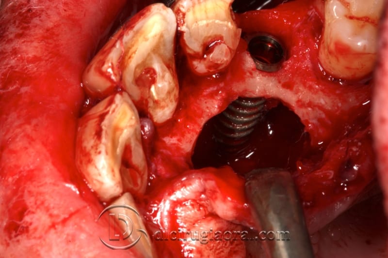 extraction of impacted canine