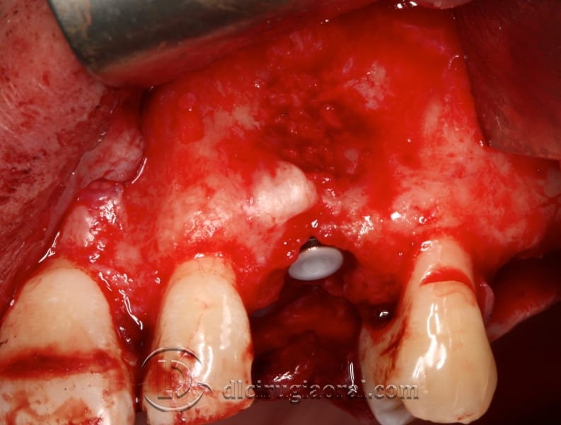 extraction of impacted canine