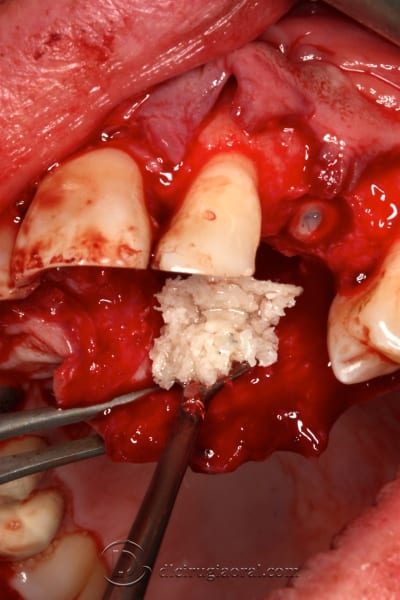 extraction of impacted canine
