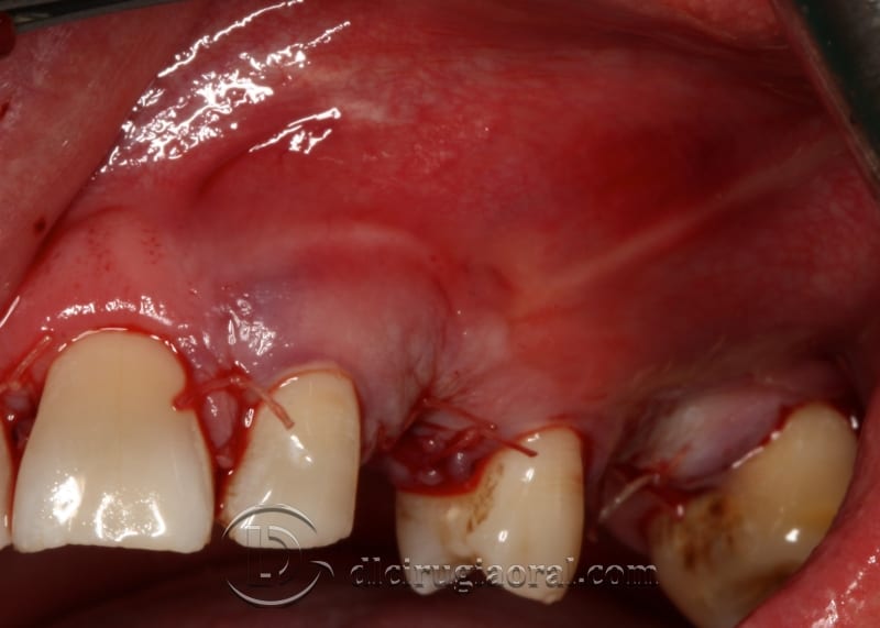 extraction of impacted canine