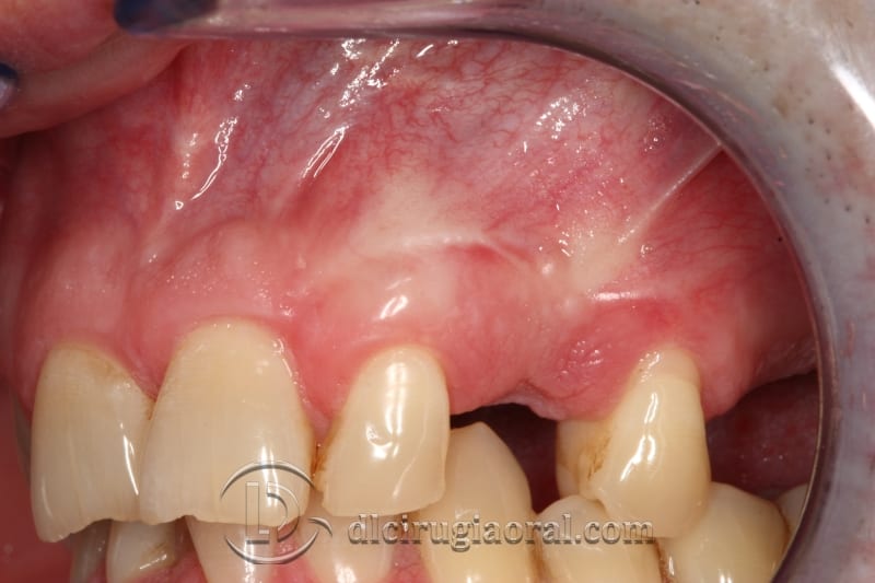 extraction of impacted canine