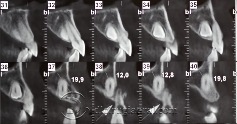 extraction of impacted canine
