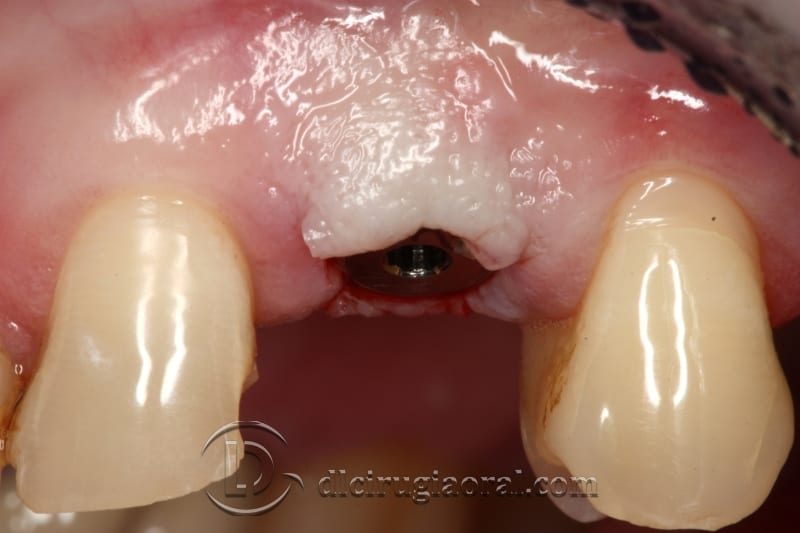 extraction of impacted canine