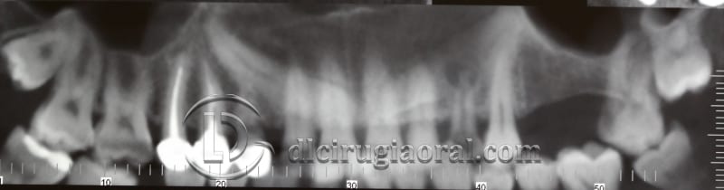 extraction of impacted canine