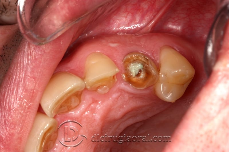 extraction of impacted canine