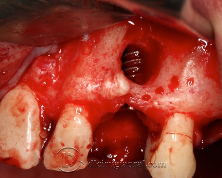 extraction of impacted canine