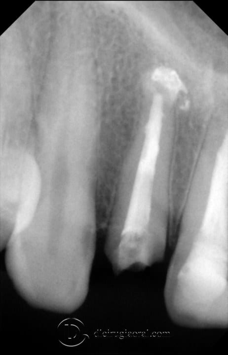 post-extraction implant