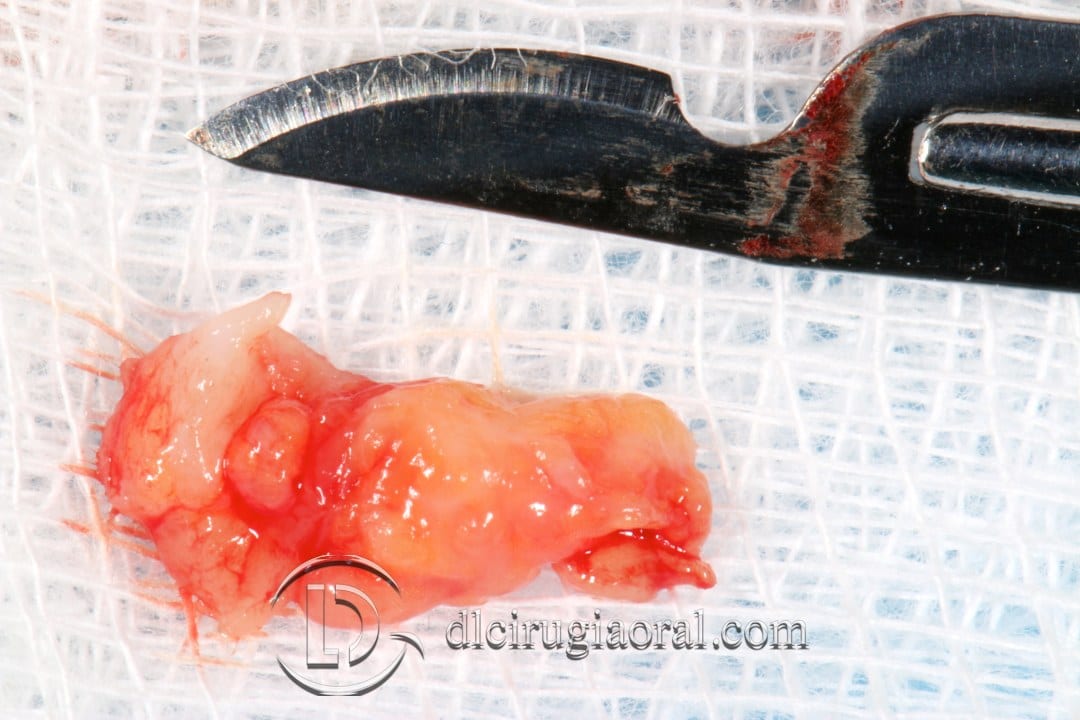 Post-Extraction Implant in the Anterior Zone with Connective Tissue Graft