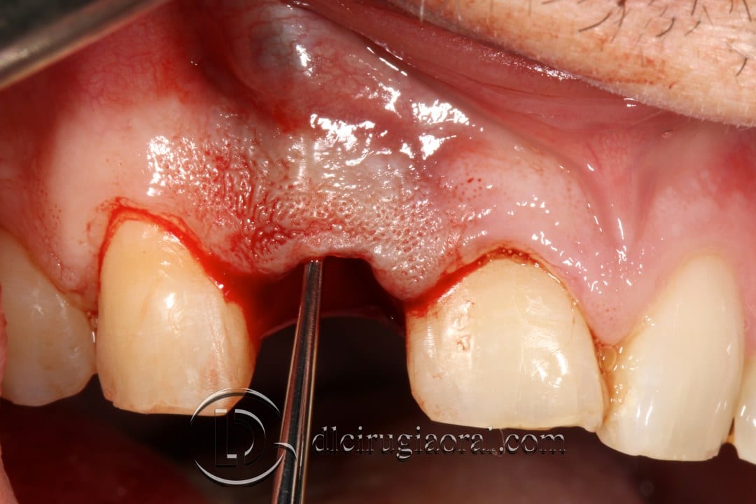 post-extraction implant
