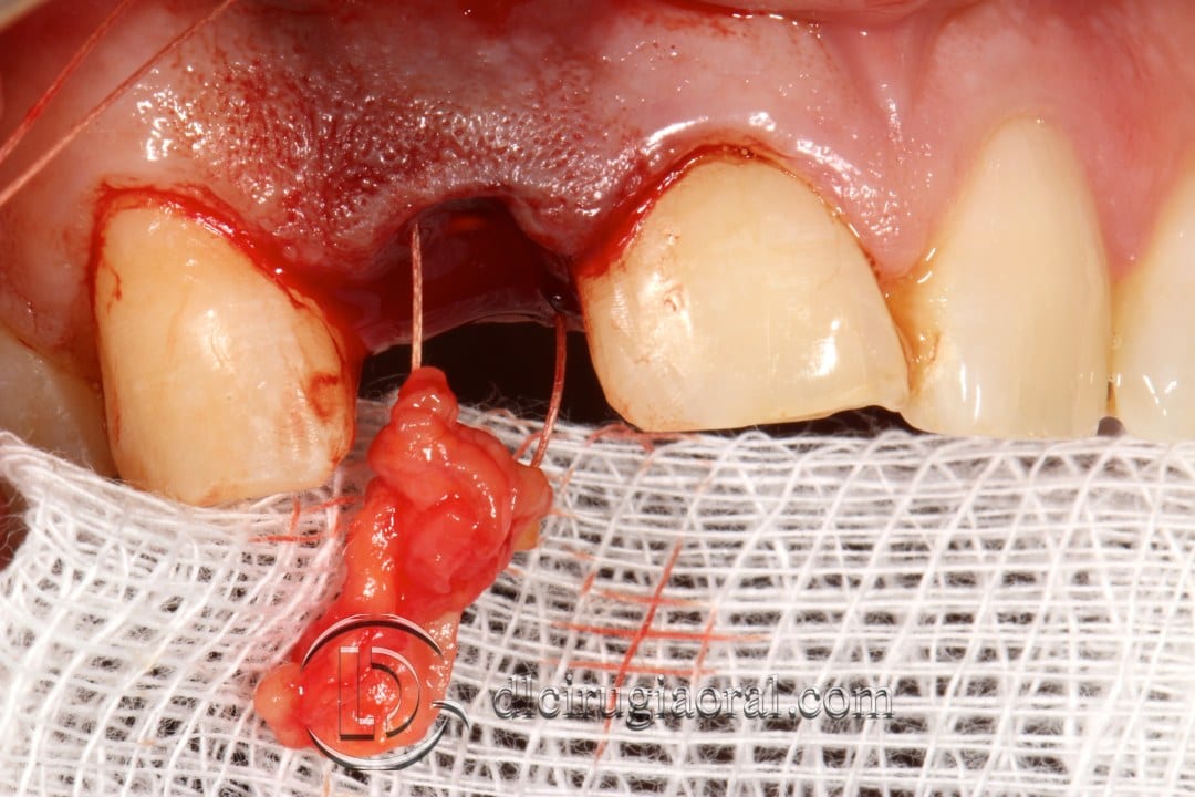 post-extraction implant