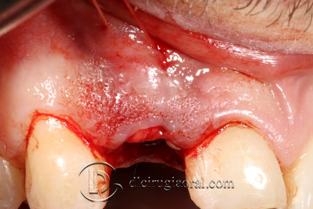 post-extraction implant