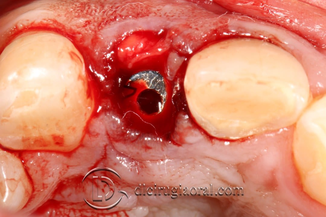 post-extraction implant