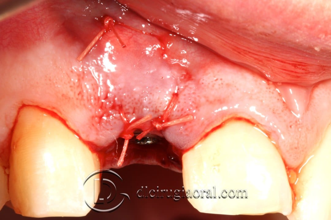 post-extraction implant