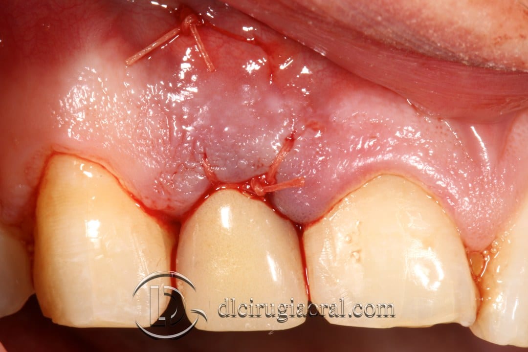 post-extraction implant