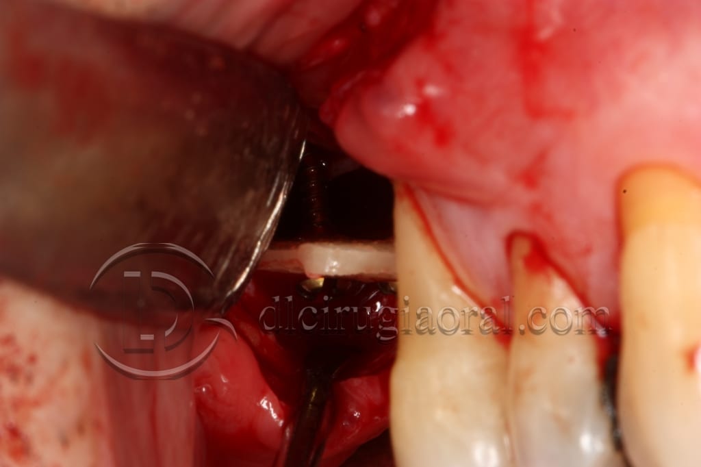 Course in maxillary reconstruction