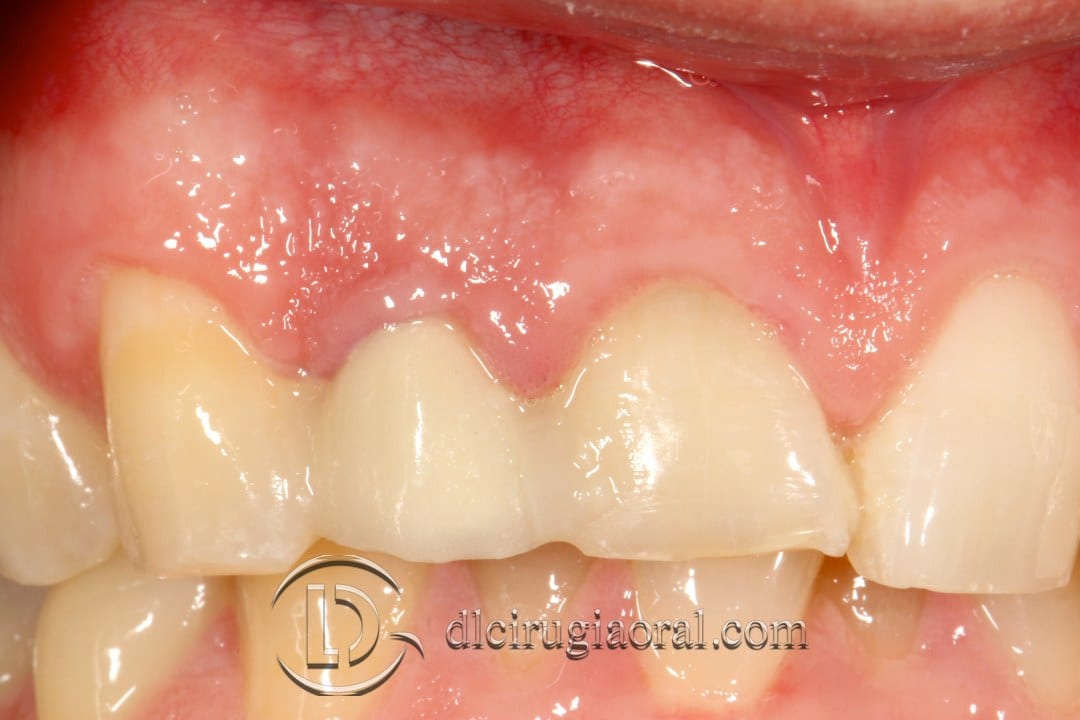 post-extraction implant