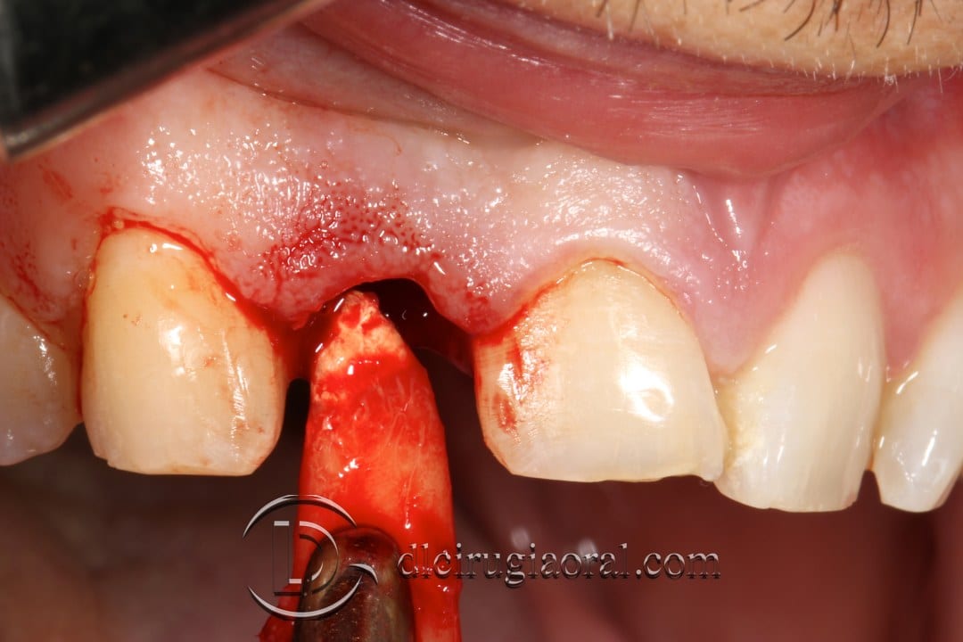 post-extraction implant