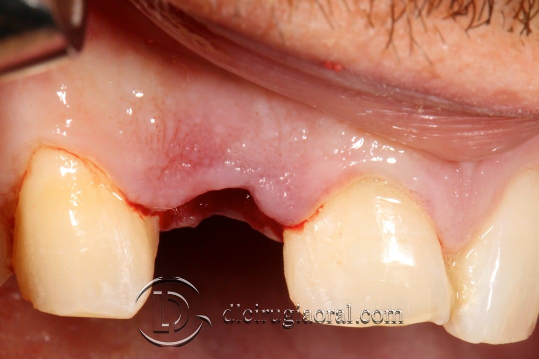 post-extraction implant